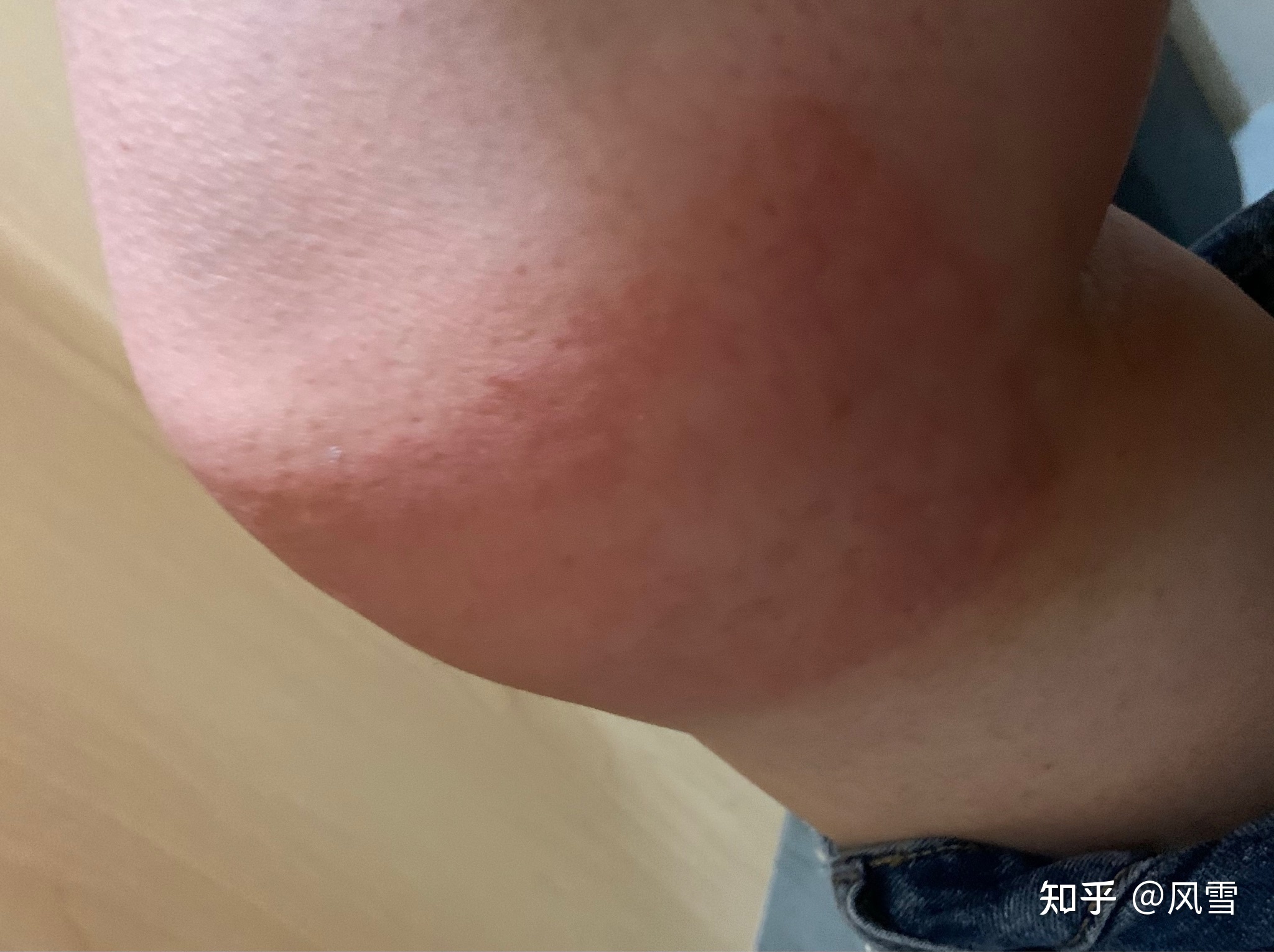 1、貼膏藥過(guò)敏癢紅腫怎么辦？