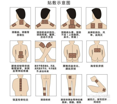 1、肩痛買(mǎi)什么膏藥可以貼？