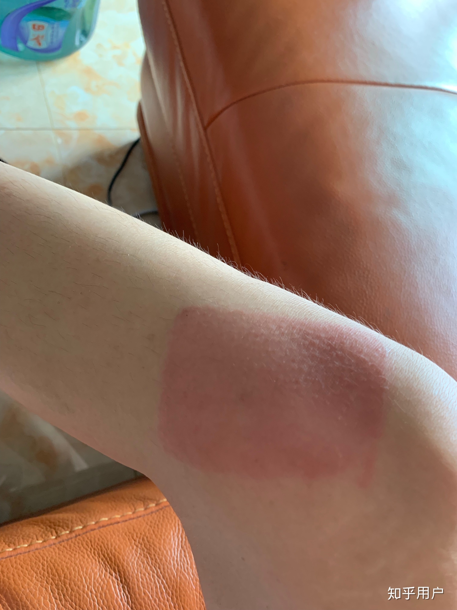 2、貼膏藥的地方有很多紅疙瘩，好不好？